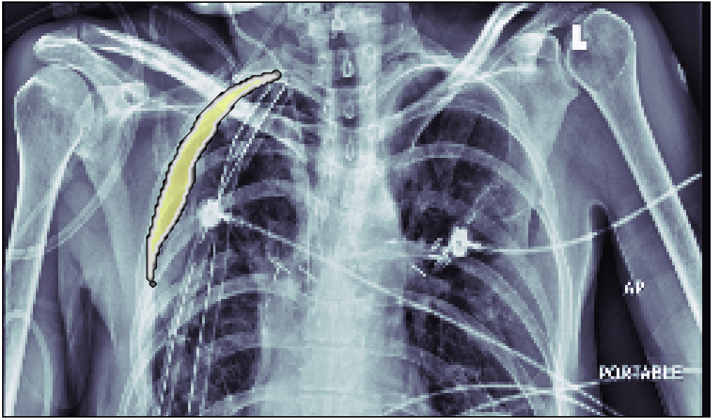 xray example